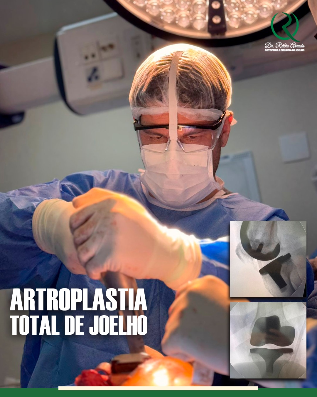 Dr. Rúbio Arruda em centro cirúrgico realizando artroplastia total de joelho